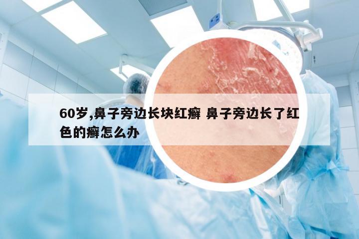 60岁,鼻子旁边长块红癣 鼻子旁边长了红色的癣怎么办