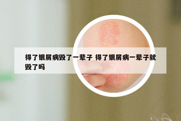 得了银屑病毁了一辈子 得了银屑病一辈子就毁了吗