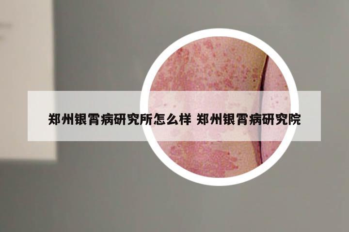 郑州银霄病研究所怎么样 郑州银霄病研究院