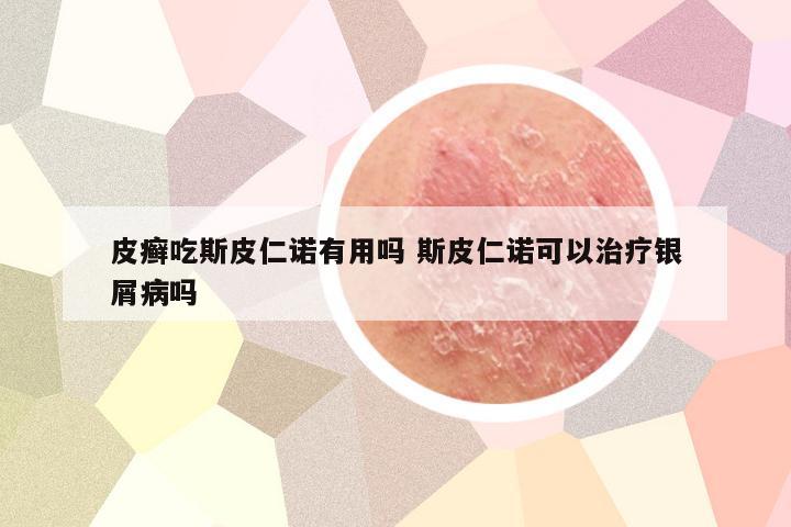 皮癣吃斯皮仁诺有用吗 斯皮仁诺可以治疗银屑病吗