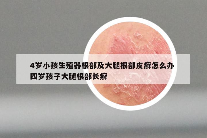 4岁小孩生殖器根部及大腿根部皮癣怎么办 四岁孩子大腿根部长癣