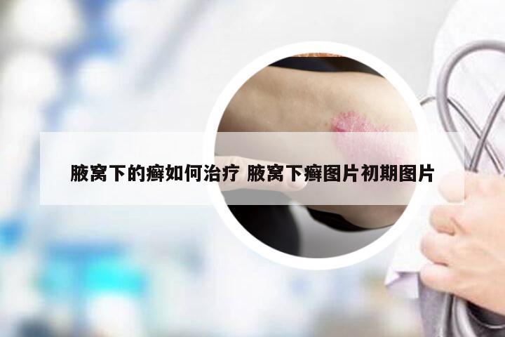 腋窝下的癣如何治疗 腋窝下癣图片初期图片