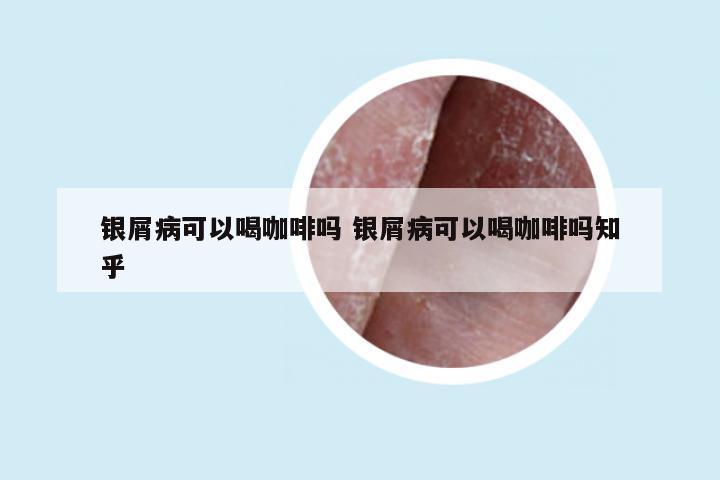 银屑病可以喝咖啡吗 银屑病可以喝咖啡吗知乎