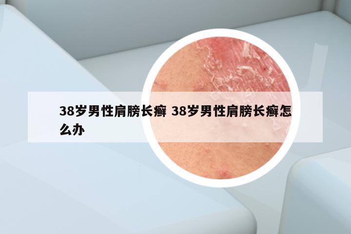 38岁男性肩膀长癣 38岁男性肩膀长癣怎么办