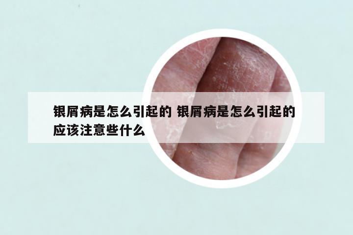 银屑病是怎么引起的 银屑病是怎么引起的 应该注意些什么