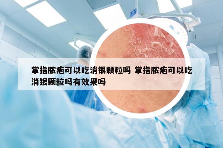 掌指脓疱可以吃消银颗粒吗 掌指脓疱可以吃消银颗粒吗有效果吗