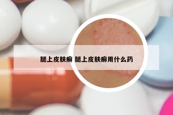 腿上皮肤癣 腿上皮肤癣用什么药