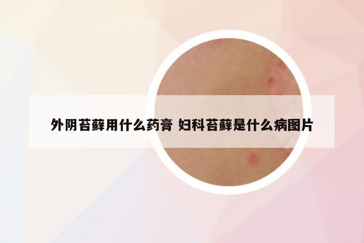 外阴苔藓用什么药膏 妇科苔藓是什么病图片