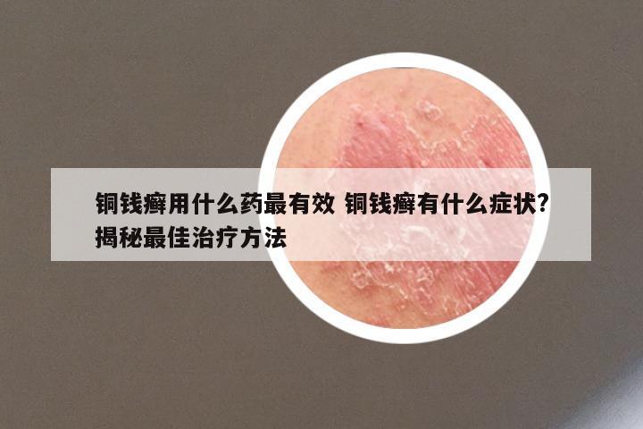 铜钱癣用什么药最有效 铜钱癣有什么症状?揭秘最佳治疗方法