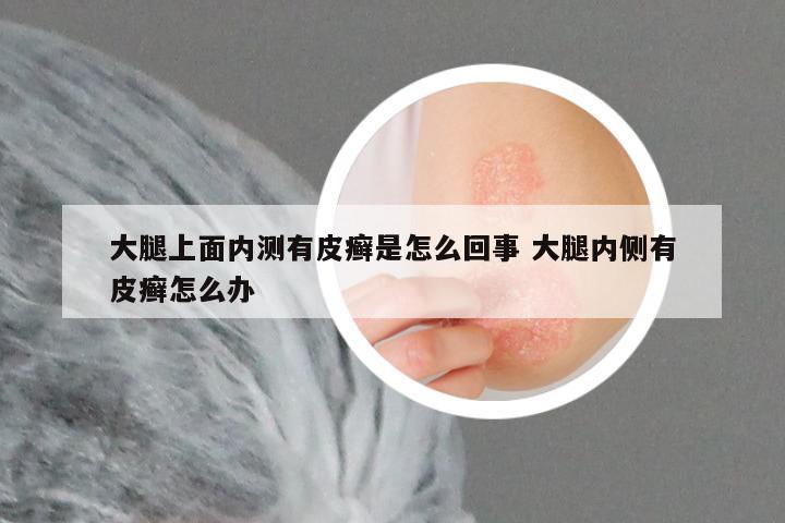 大腿上面内测有皮癣是怎么回事 大腿内侧有皮癣怎么办