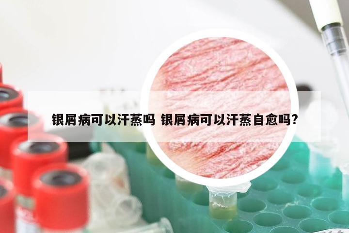 银屑病可以汗蒸吗 银屑病可以汗蒸自愈吗?