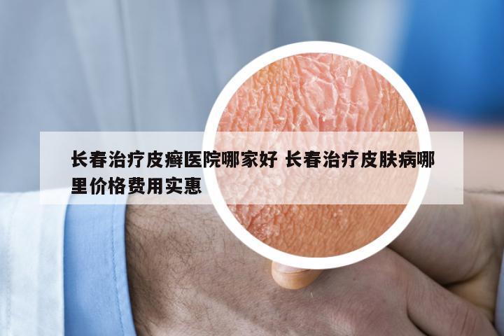 长春治疗皮癣医院哪家好 长春治疗皮肤病哪里价格费用实惠