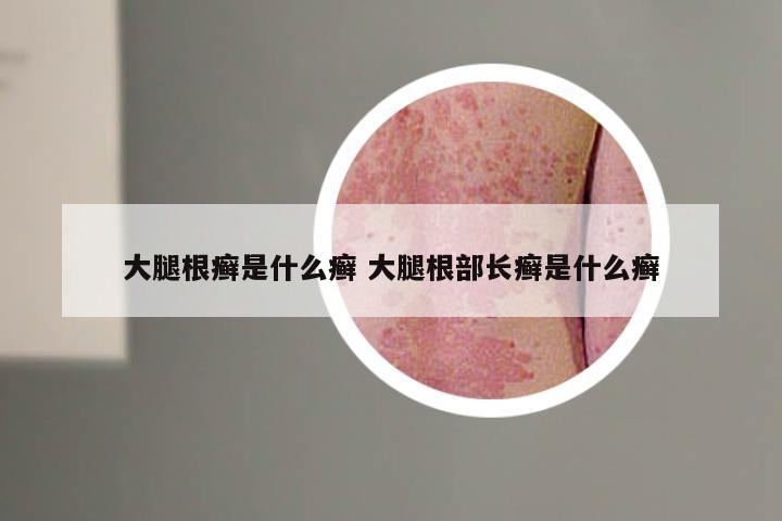 大腿根癣是什么癣 大腿根部长癣是什么癣