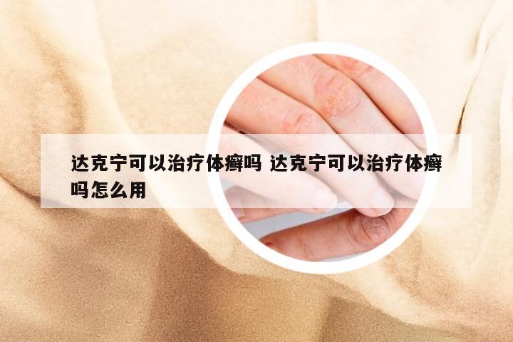 达克宁可以治疗体癣吗 达克宁可以治疗体癣吗怎么用