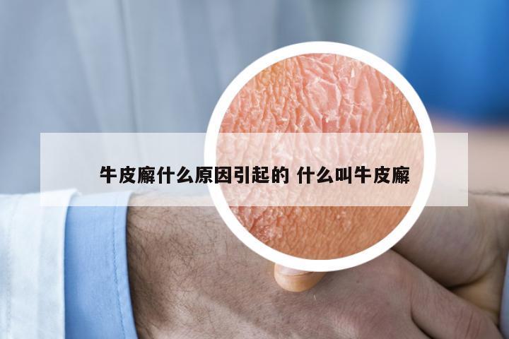 牛皮廨什么原因引起的 什么叫牛皮廨