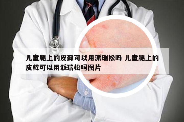 儿童腿上的皮藓可以用派瑞松吗 儿童腿上的皮藓可以用派瑞松吗图片