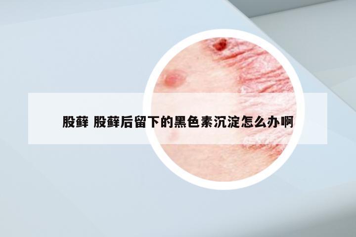 股藓 股藓后留下的黑色素沉淀怎么办啊