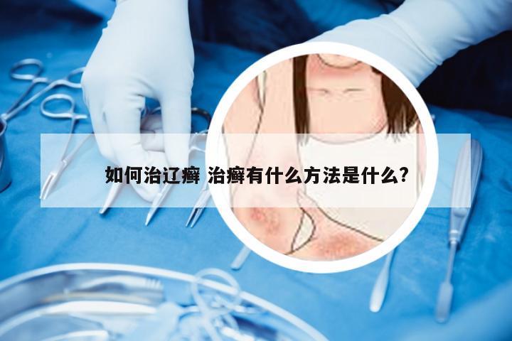 如何治辽癣 治癣有什么方法是什么?