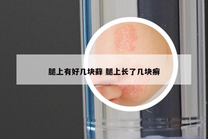 腿上有好几块藓 腿上长了几块癣