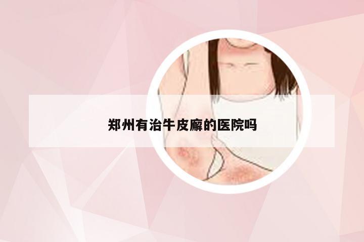 郑州有治牛皮廨的医院吗