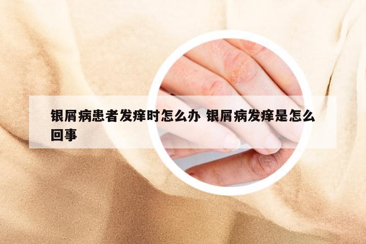 银屑病患者发痒时怎么办 银屑病发痒是怎么回事