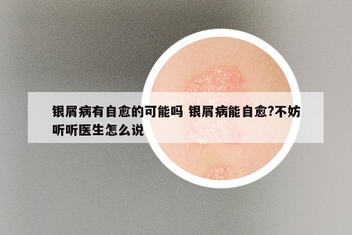 银屑病有自愈的可能吗 银屑病能自愈?不妨听听医生怎么说