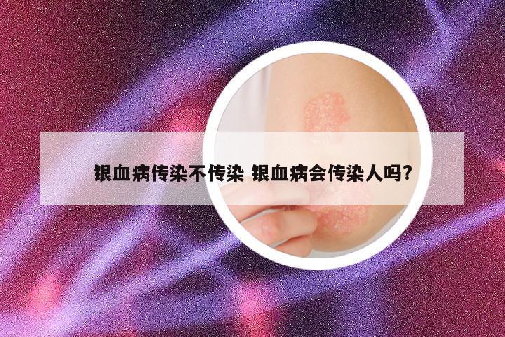 银血病传染不传染 银血病会传染人吗?