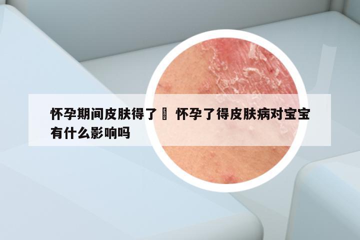 怀孕期间皮肤得了廯 怀孕了得皮肤病对宝宝有什么影响吗