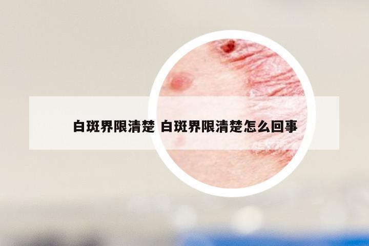 白斑界限清楚 白斑界限清楚怎么回事