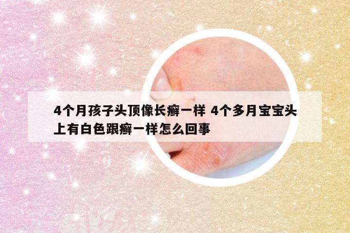 4个月孩子头顶像长癣一样 4个多月宝宝头上有白色跟癣一样怎么回事