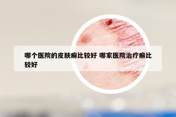 哪个医院的皮肤癣比较好 哪家医院治疗癣比较好