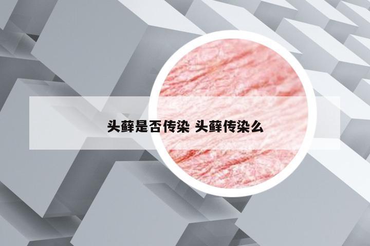 头藓是否传染 头藓传染么