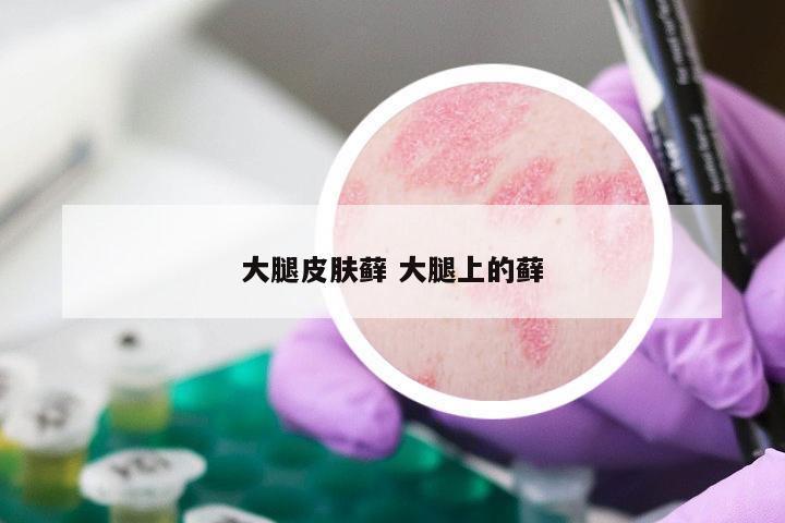 大腿皮肤藓 大腿上的藓