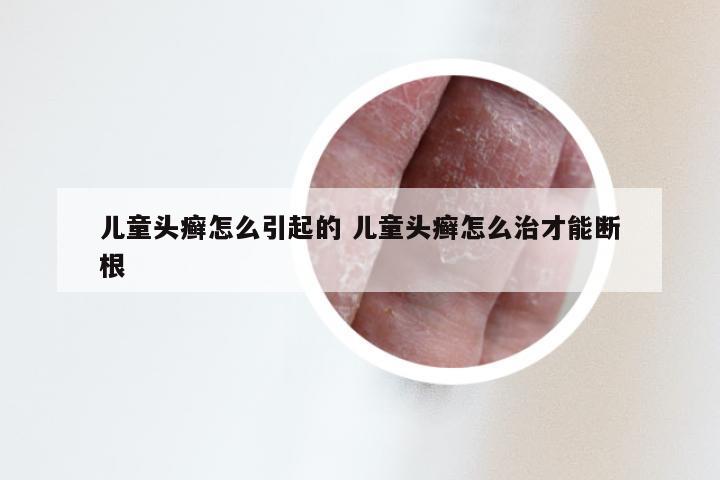 儿童头癣怎么引起的 儿童头癣怎么治才能断根