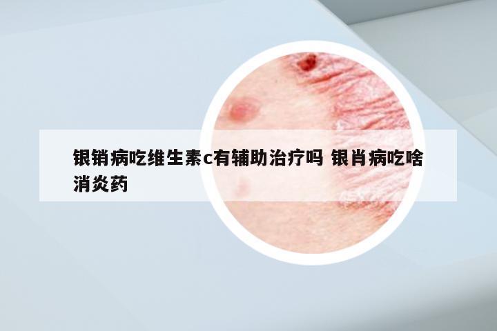 银销病吃维生素c有辅助治疗吗 银肖病吃啥消炎药