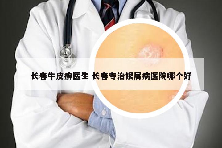 长春牛皮癣医生 长春专治银屑病医院哪个好