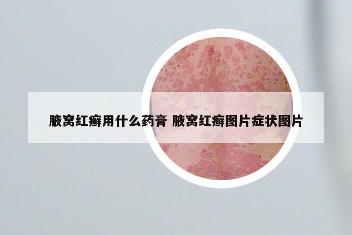 腋窝红癣用什么药膏 腋窝红癣图片症状图片