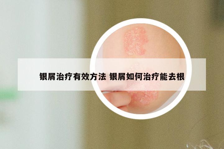 银屑治疗有效方法 银屑如何治疗能去根