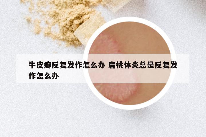 牛皮癣反复发作怎么办 扁桃体炎总是反复发作怎么办