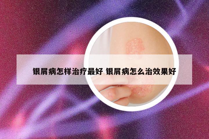 银屑病怎样治疗最好 银屑病怎么治效果好