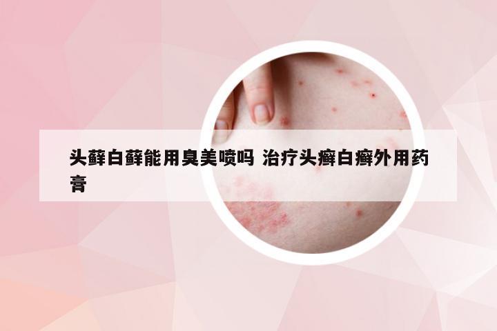 头藓白藓能用臭美喷吗 治疗头癣白癣外用药膏