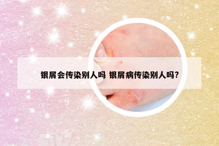 银屑会传染别人吗 银屑病传染别人吗?