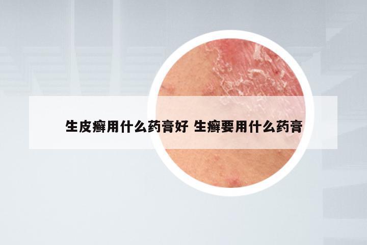 生皮癣用什么药膏好 生癣要用什么药膏