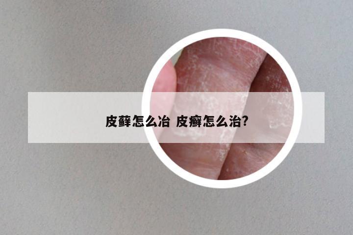 皮藓怎么冶 皮癣怎么治?