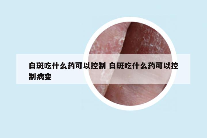 白斑吃什么药可以控制 白斑吃什么药可以控制病变