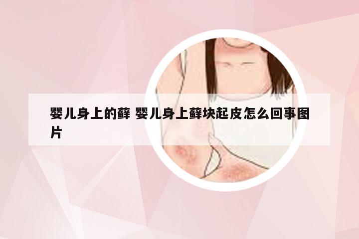 婴儿身上的藓 婴儿身上藓块起皮怎么回事图片