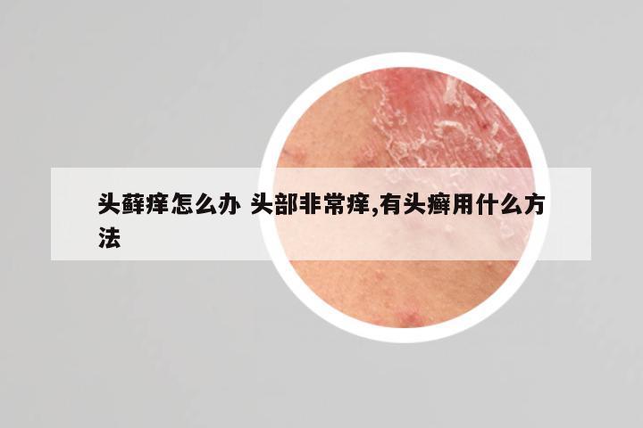 头藓痒怎么办 头部非常痒,有头癣用什么方法