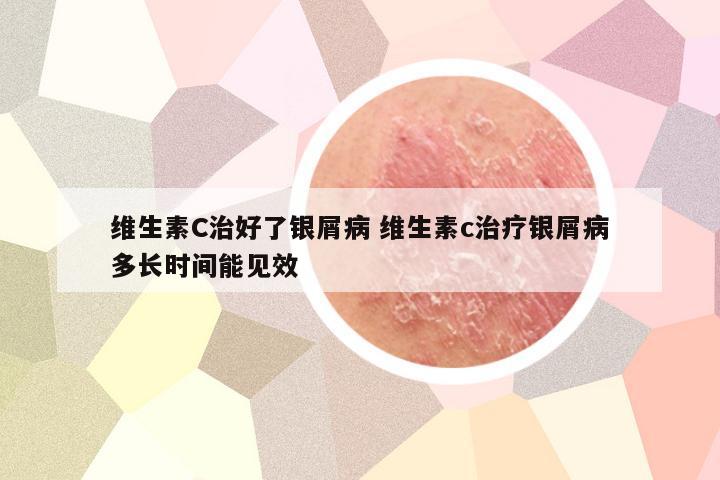 维生素C治好了银屑病 维生素c治疗银屑病多长时间能见效