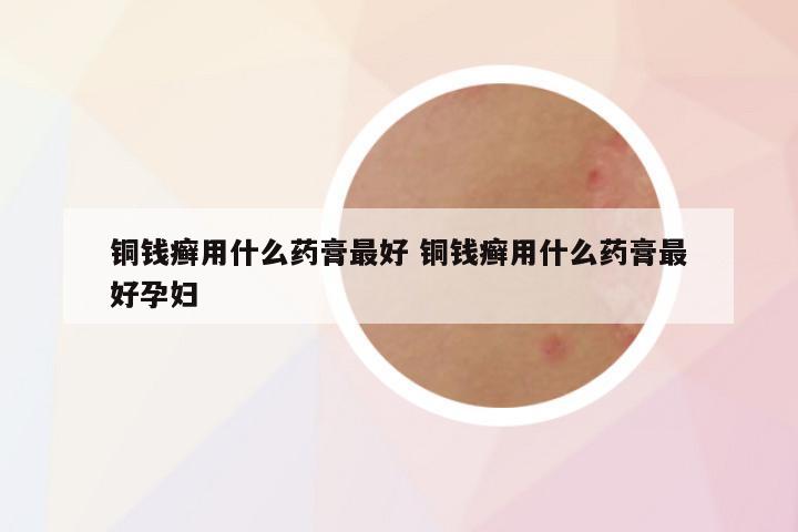 铜钱癣用什么药膏最好 铜钱癣用什么药膏最好孕妇