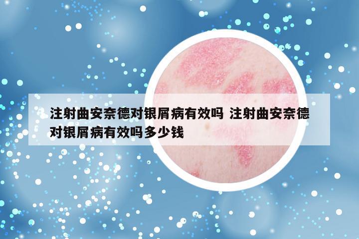 注射曲安奈德对银屑病有效吗 注射曲安奈德对银屑病有效吗多少钱